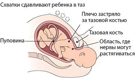 родовая травма.jpg